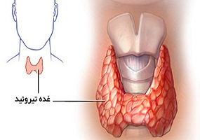 پرکاری تیروئید و بهرتین روش های درمان و پیشگیری